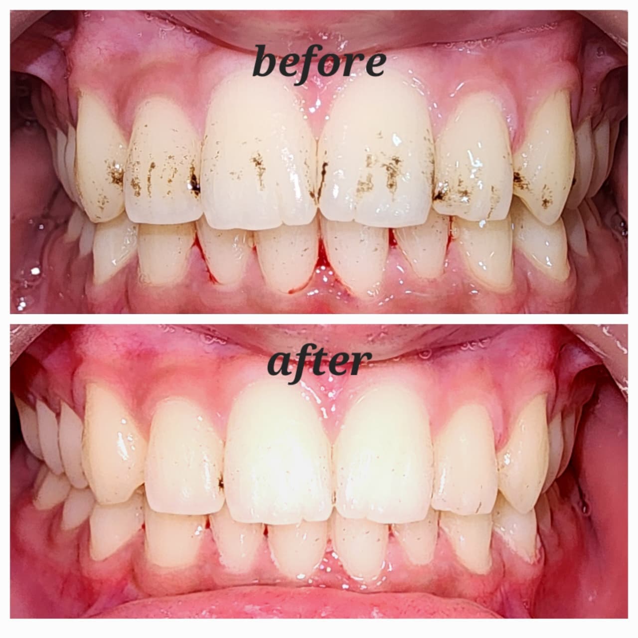 Smile Transformation before and after dental treatment result