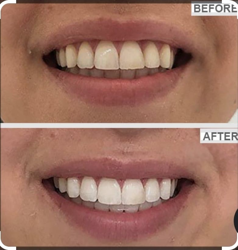 Complete Smile Rehabilitation before and after dental treatment result