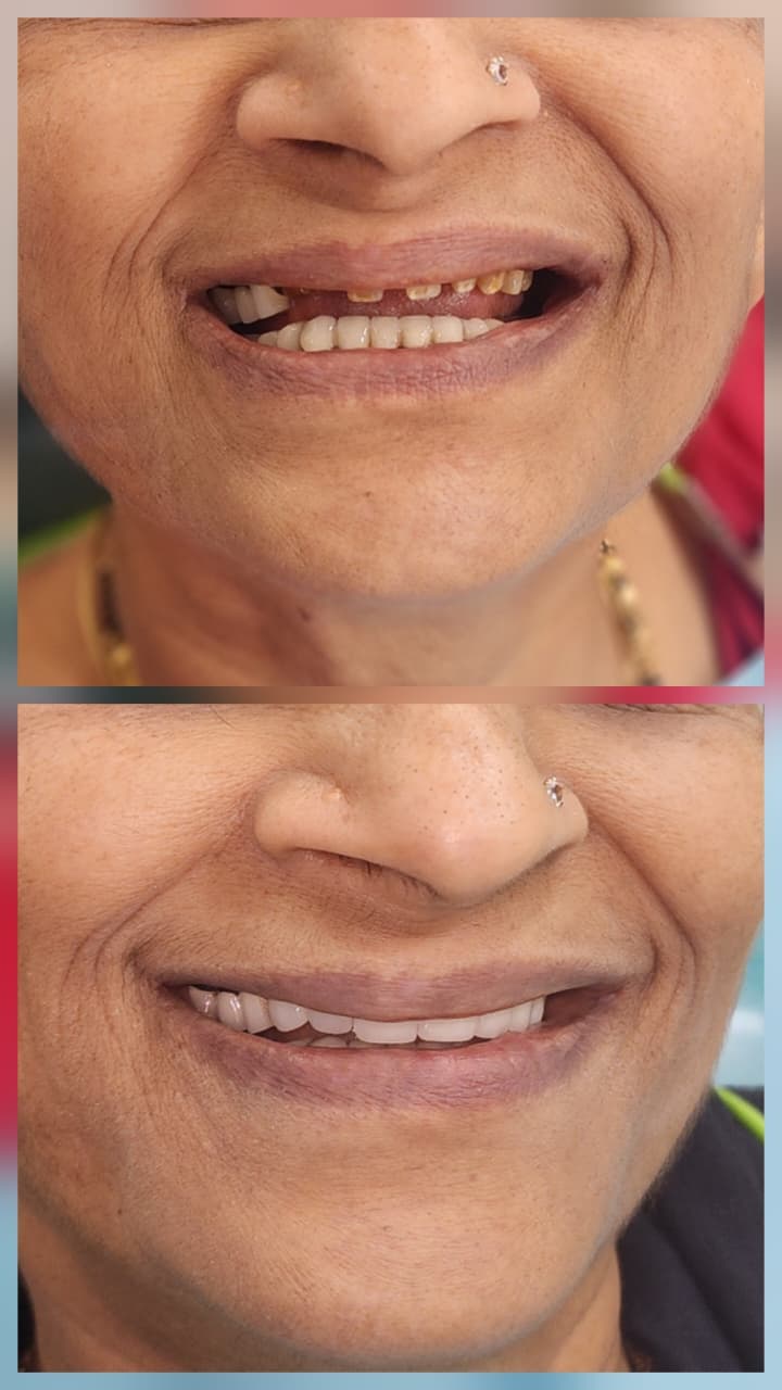 Advanced Dental Restoration before and after dental treatment result